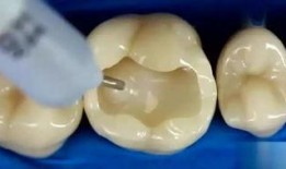 补牙全过程爆料视频播放,从检查到恢复，一视频看尽牙齿修复全流程