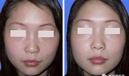 美容院祛斑爆料视频,真实效果与潜在风险大曝光